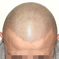 Dermatrico Repair [Tricopigmentazione] Selargius, Su Planu - Orari di apertura